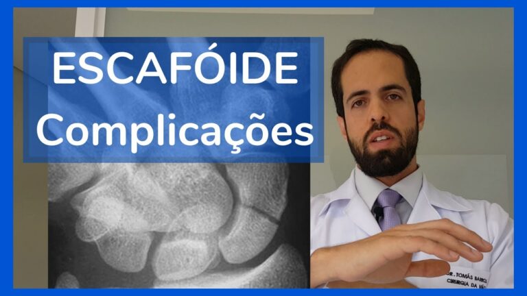 Escafoide Carpiano: Função, Lesões e Tratamento