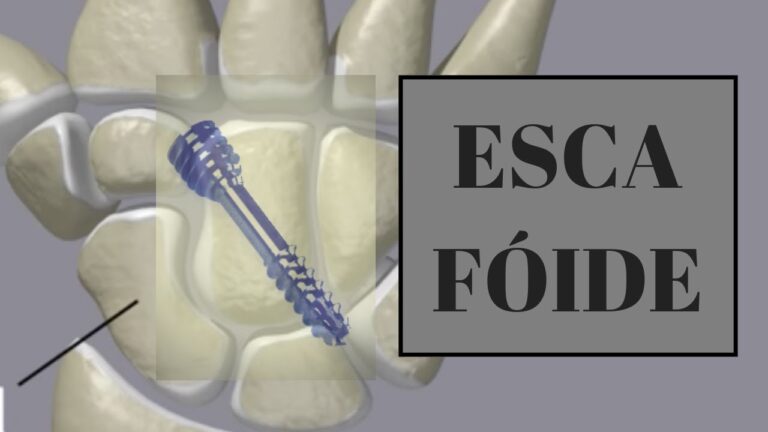 A import&acirc;ncia do escaf&oacute;ide carpiano na sa&uacute;de das m&atilde;os