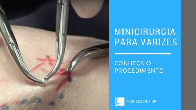 Operação de Varizes: Tudo o que você precisa saber